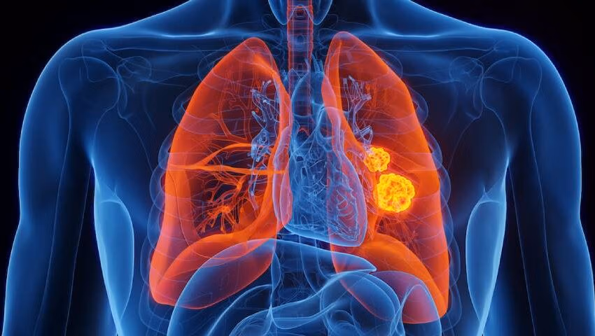 Interstitial lung Disease Image
